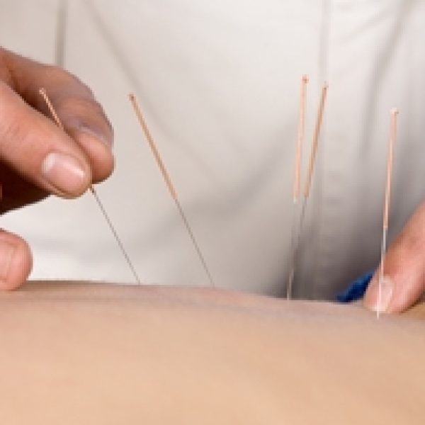 acupuncture